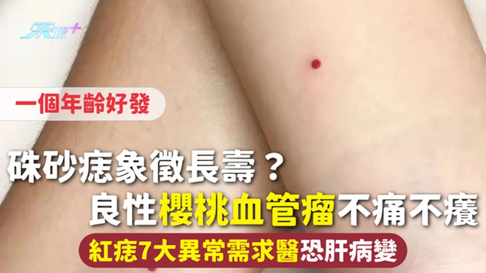 硃砂痣 | 象徵長壽？良性櫻桃血管瘤不痛不癢一個年齡好發 紅痣7大異常需求醫恐肝病變