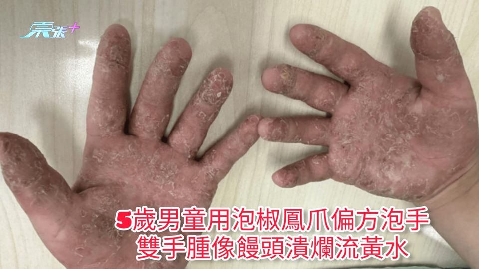 偏方不可信 | 5歲男童用泡椒鳳爪偏方泡手 雙手腫像饅頭潰爛流黃水