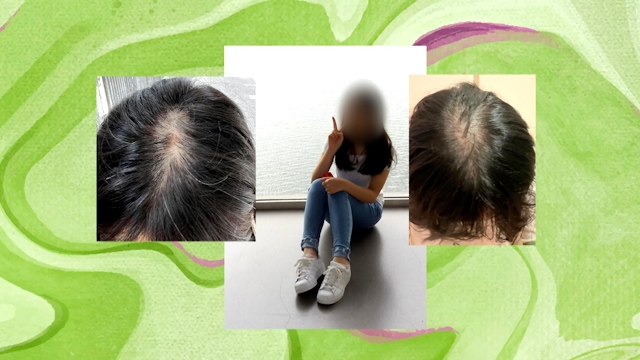 化名Angie的年輕女子由十七、八歲開始頭頂脫髮，多年試過不同方法仍未改善，甚至被男朋友嫌棄。