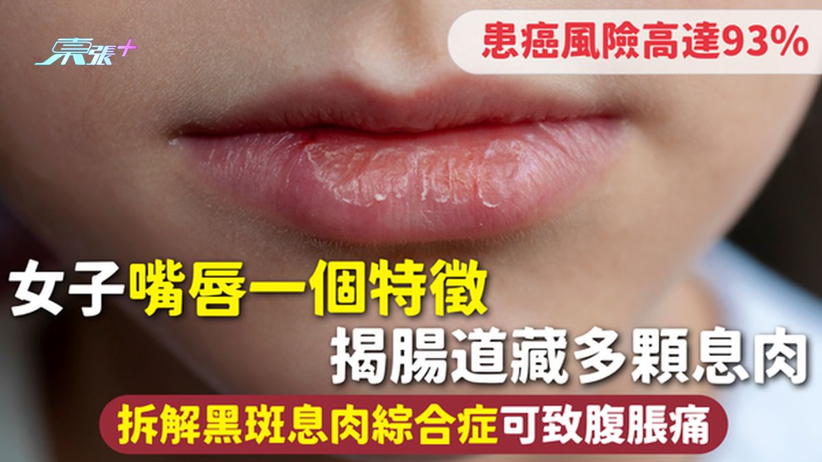 身體警號｜女子嘴唇一個特徵 揭腸道藏多顆息肉 拆解黑斑息肉綜合症可致腹脹痛 患癌風險高達93%