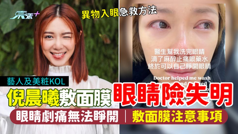 藝人倪晨曦敷面膜眼睛險失明 眼睛劇痛無法睜開/角膜險受損/敷面膜注意事項/異物入眼急救方法