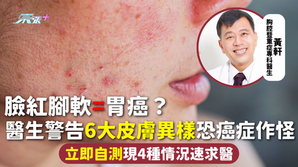 皮膚變化 | 臉紅腳軟=胃癌？醫生警告6大皮膚異樣恐癌症作怪 立即自測現4種情況速求醫