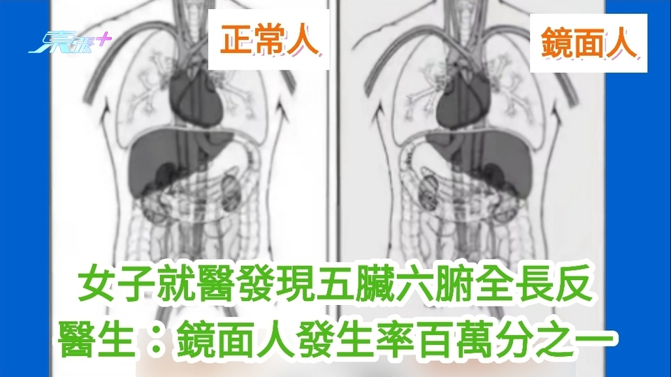 有片｜女子就醫發現五臟六腑全長反 醫生：鏡面人發生率百萬分之一
