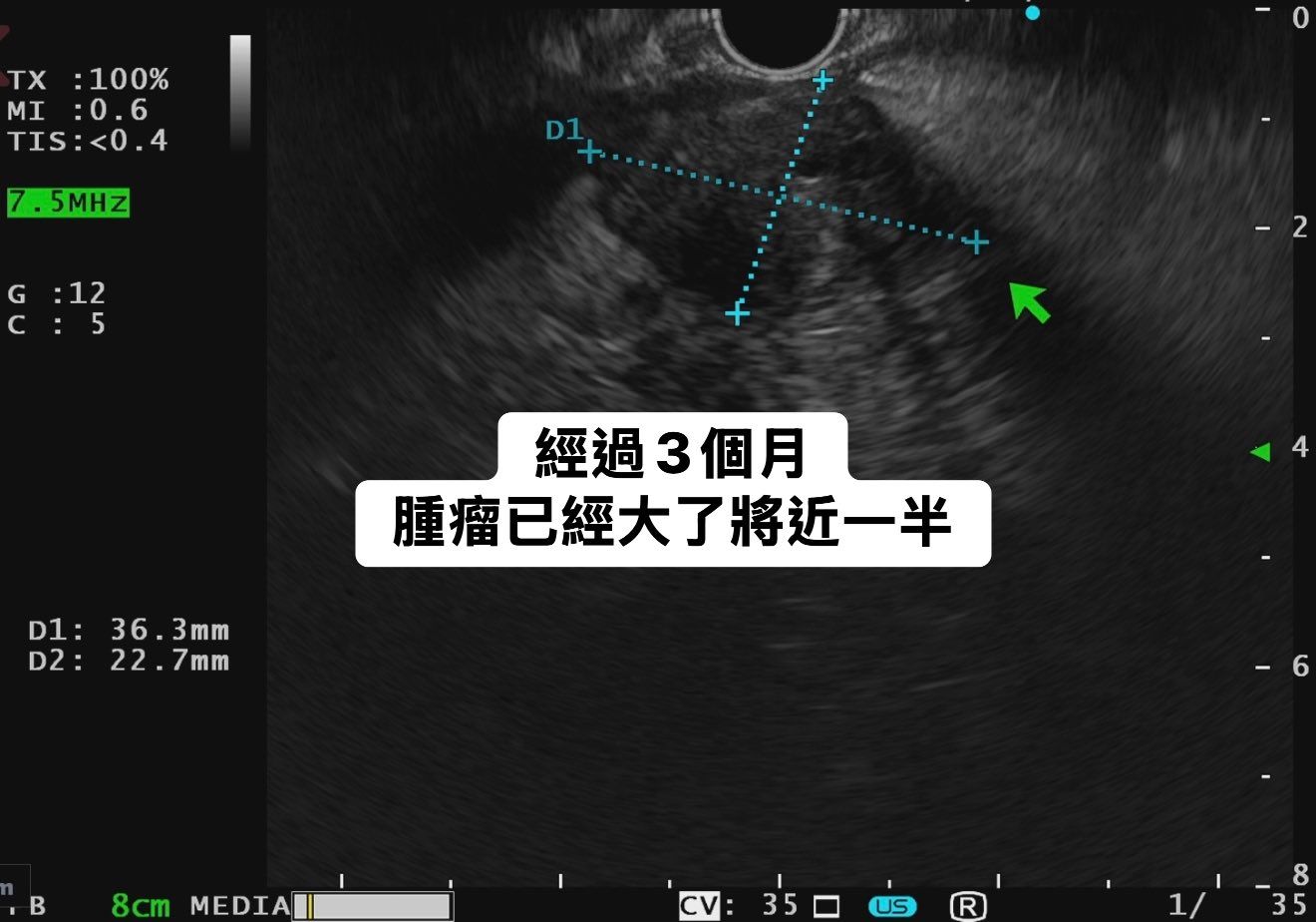 May be an image of xray and text that says 'TX ×:100% ：100% MI :0.6 MI:0.6 6 TIS:<0.4 5MHZ D1 G G:12 :12 c C:5 5 f -2 D1: D1:36.3mm 36.3 36 3mm D2: 22.7mm 7mm 經過3個月 腫瘤已經大了將近一半 4 B -6 8cm MEDIA| 8 'cv: 3月:18 :350 R 350 นร 35'