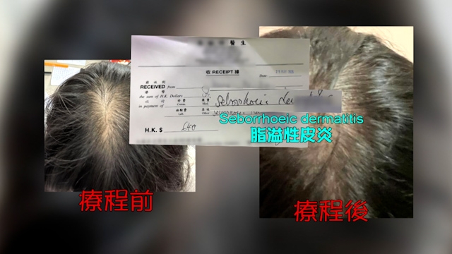 求醫後確認為脂溢性皮炎。
