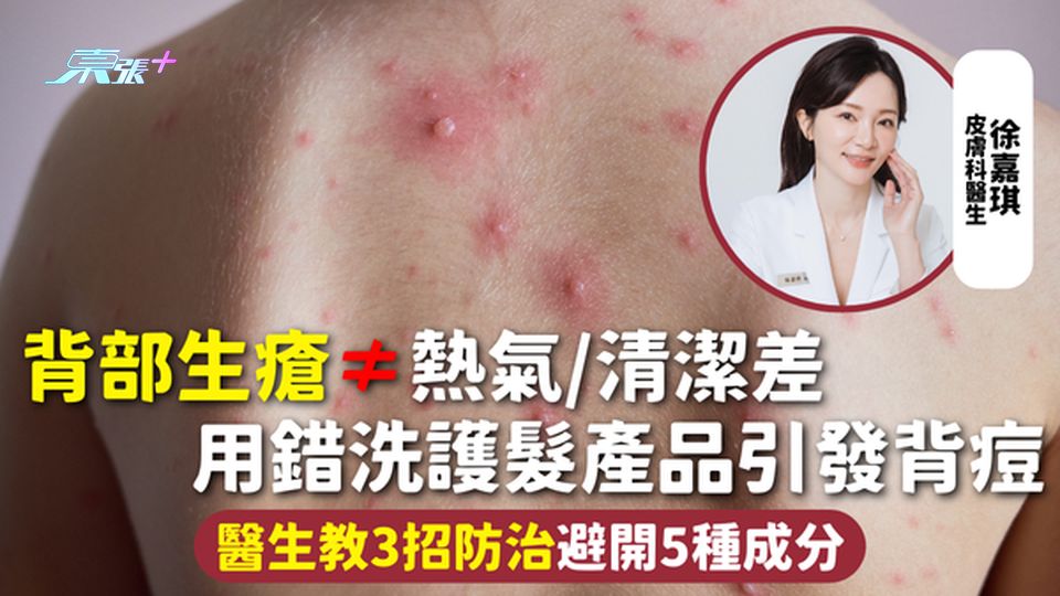 背痘 | 背部生瘡≠熱氣/清潔差 用錯洗護髮產品引發背痘 醫生教3招防治避開5種成分