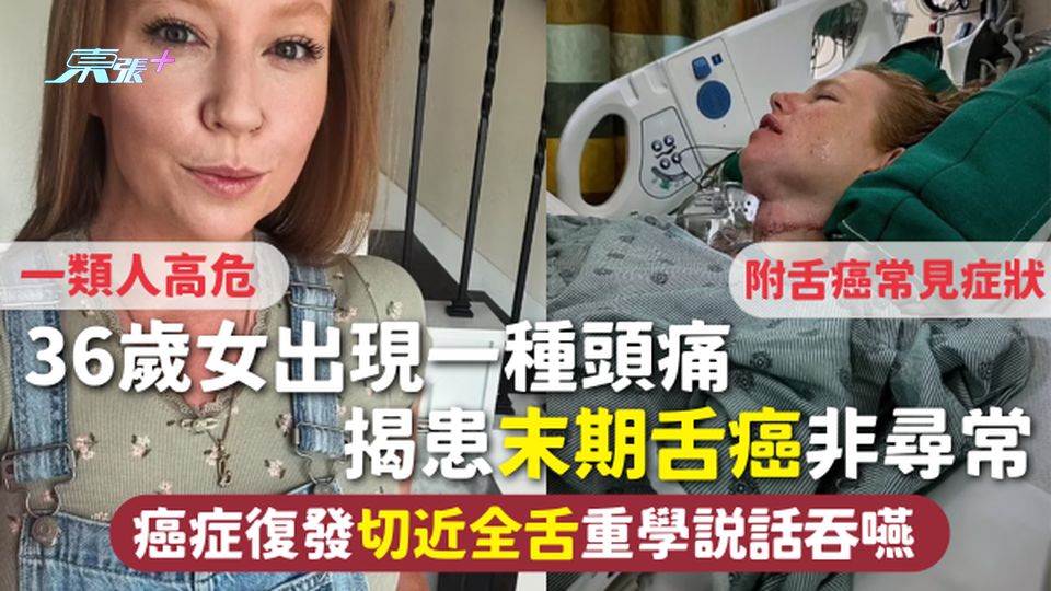 舌癌 | 36歲女出現一種頭痛 揭患末期舌癌非尋常 切近全舌重學說話吞嚥 附舌癌常見症狀 一類人高危