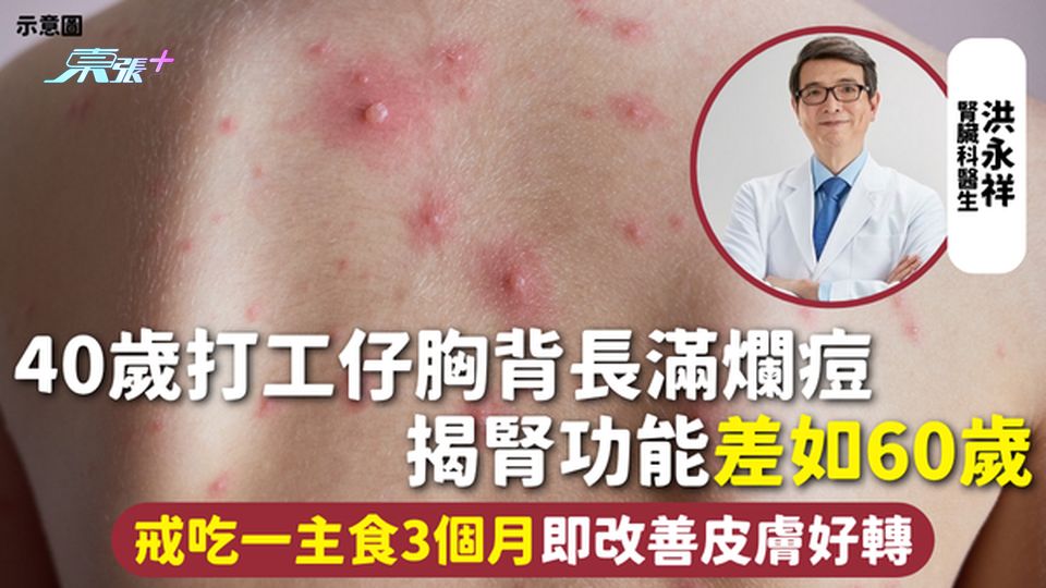 腎臟健康 | 40歲打工仔胸背長滿爛痘 揭腎功能差如60歲 戒吃一主食3個月即改善皮膚好轉