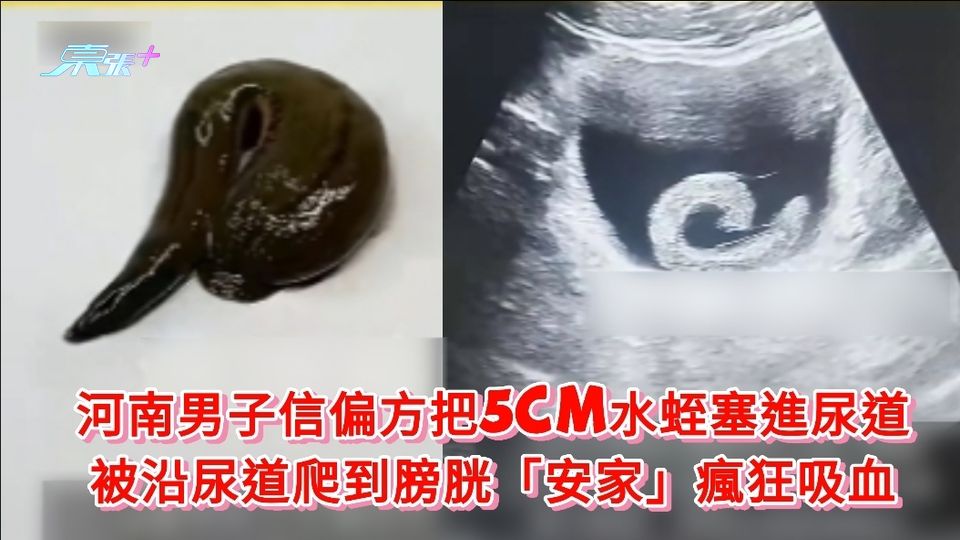 河南男子信偏方把5cm水蛭塞進尿道 被沿尿道爬到膀胱「安家」瘋狂吸血