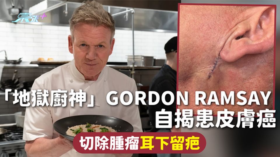 皮膚癌 | 「地獄廚神」Gordon Ramsay自揭患皮膚癌 切除腫瘤耳下留疤