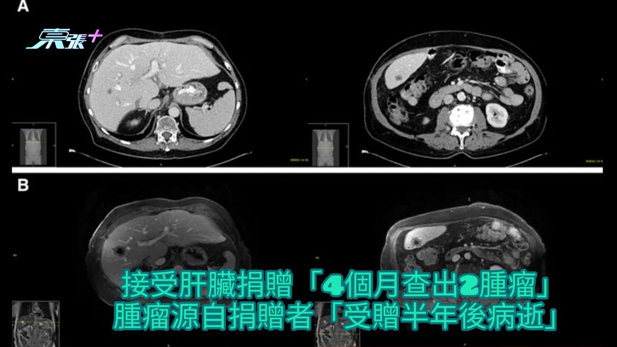 接受肝脏捐赠「4个月查出2肿瘤」 肿瘤源自捐赠者「受赠半年后病逝」