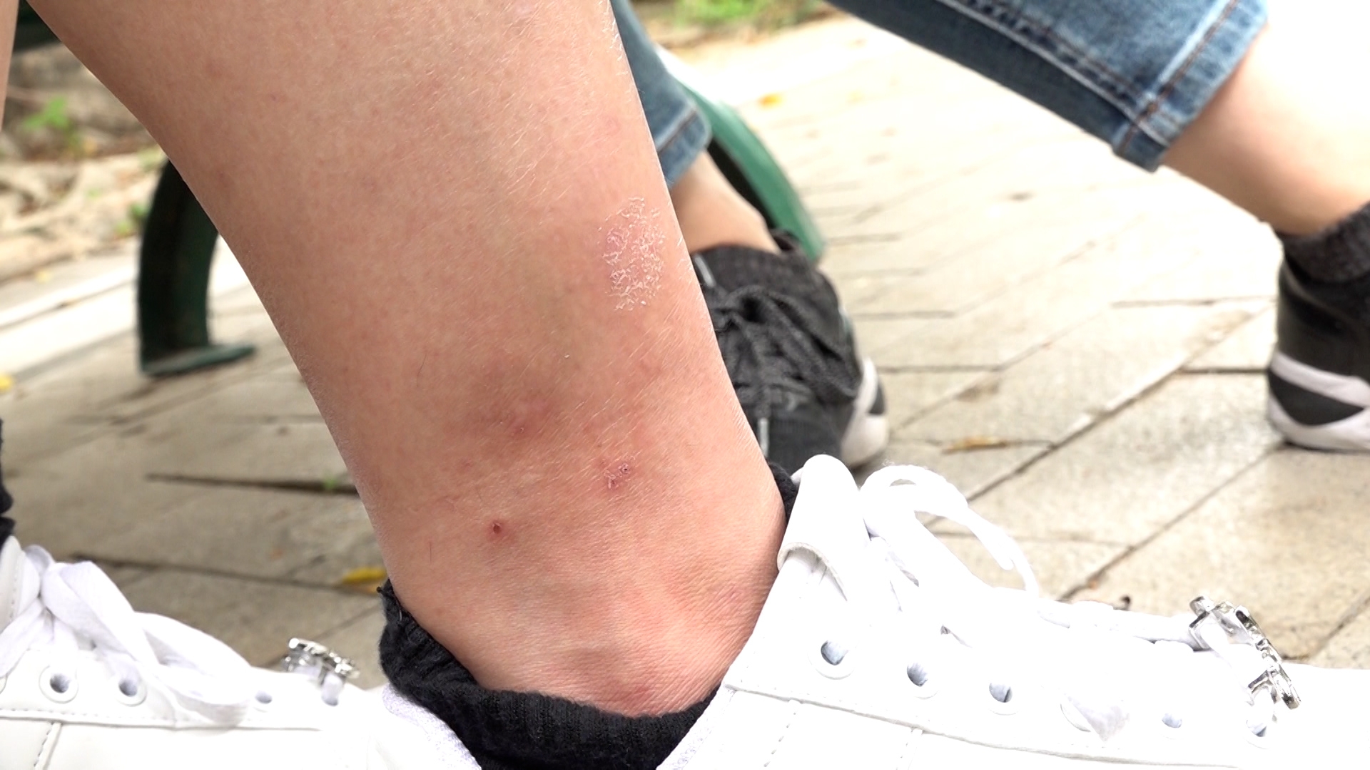 傷處當場紅腫疼痛，半個月後仍留有明顯紅印，恐會留下疤痕。