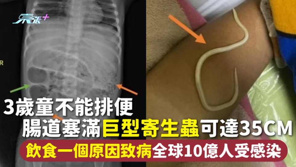 寄生蟲 | 3歲童不能排便 腸道塞滿巨型寄生蟲可達35cm 飲食一原因致病全球10億人受感染【有圖】