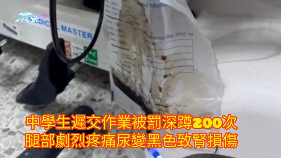 中學生遲交作業被罰深蹲200次 腿部劇烈疼痛尿變黑色致腎損傷