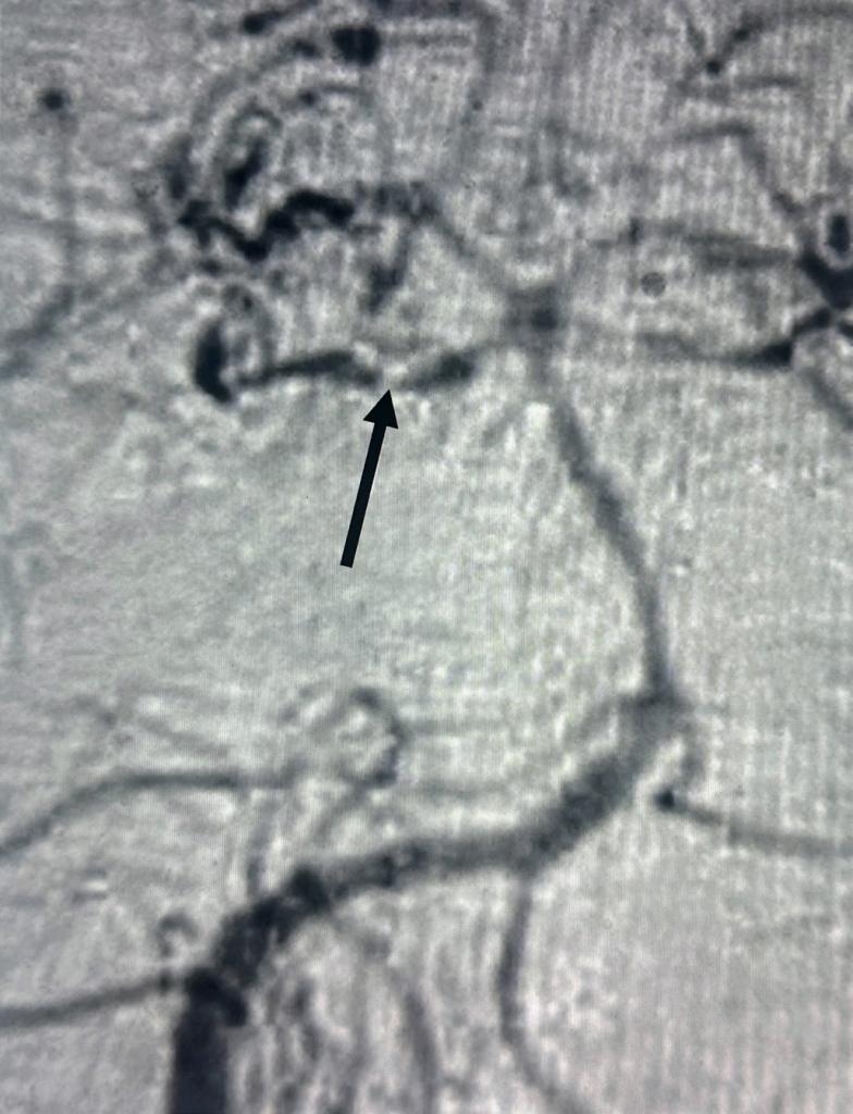 磁振造影血管攝影顯示小腦上血管痙攣（黑箭頭）。