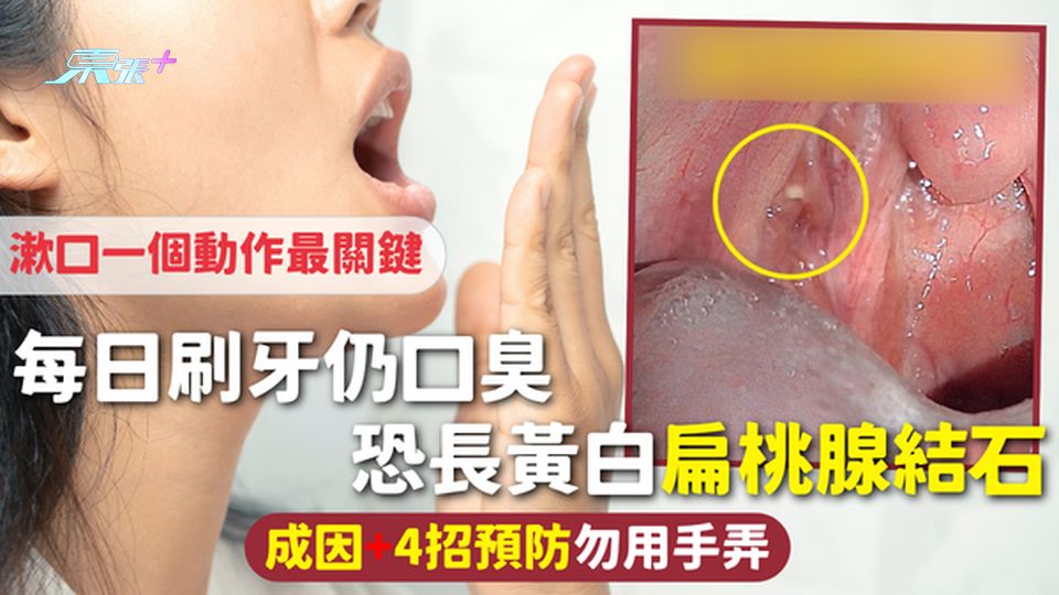 口腔結石 | 每日刷牙仍口臭 恐長黃白扁桃腺結石 成因+4招預防勿用手弄 漱口一個動作最關鍵