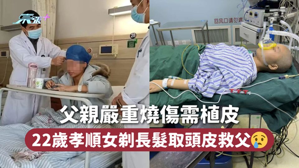 父親嚴重燒傷需植皮 22歲孝順女剃長髮取頭皮救父😢