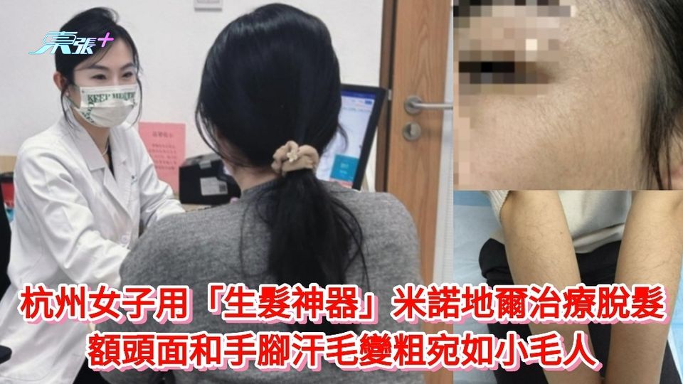 杭州女子用「生髮神器」米諾地爾治療脫髮 額頭面和手腳汗毛變粗宛如小毛人