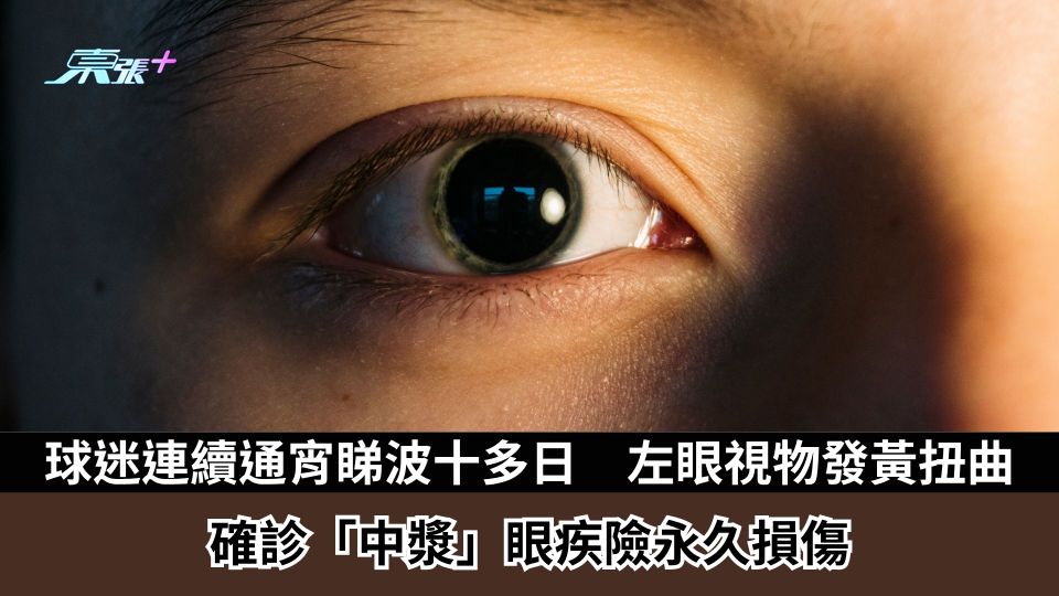 球迷連續通宵睇波十多日　左眼視物發黃扭曲　確診「中漿」眼疾險永久損傷