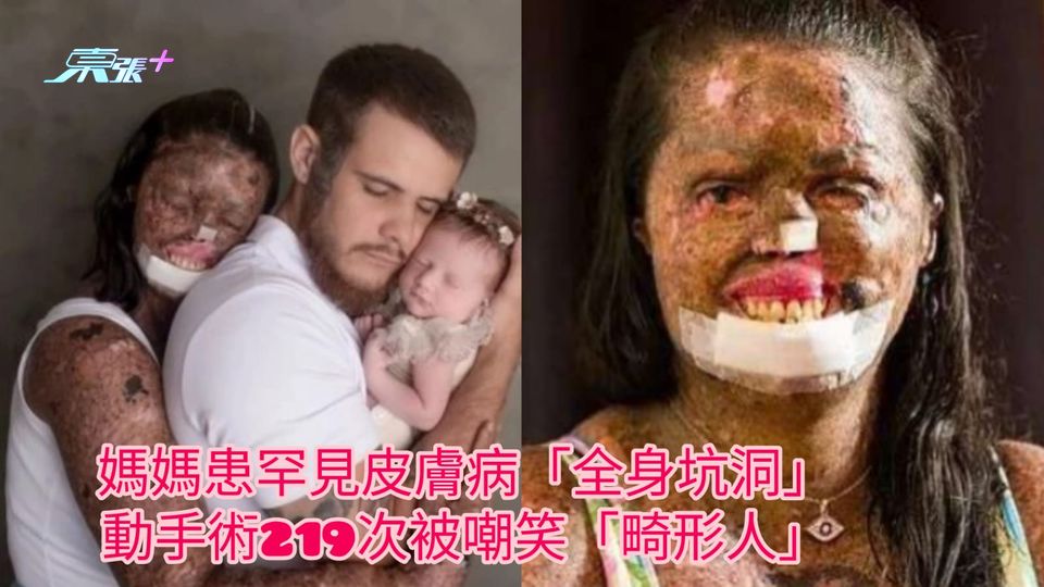 媽媽患罕見皮膚病「全身坑洞」 動手術219次被嘲笑「畸形人」