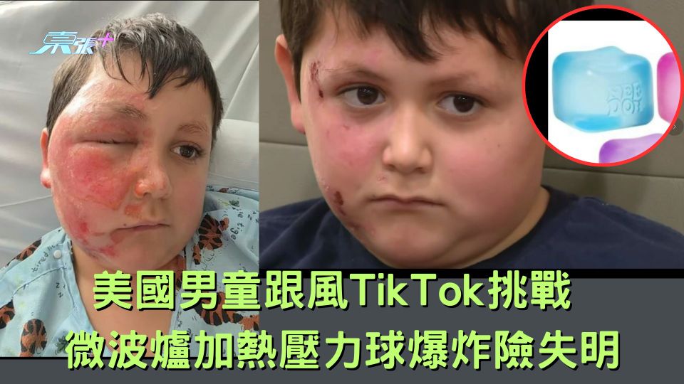 美國男童跟風TikTok挑戰 微波爐加熱壓力球爆炸險失明
