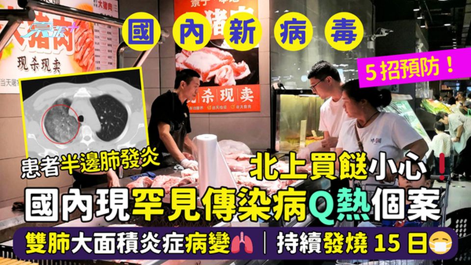 北上買餸小心❗國內現罕見傳染病Q熱個案🦠  雙肺大面積炎症病變🫁｜持續發燒15日😷