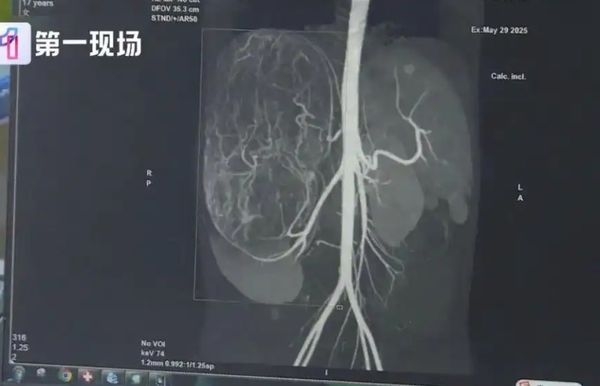 ▲▼ 17歲女孩買衣服時經店員一句提醒，發現體內藏著巨大腫瘤   。（圖／翻攝 第一現場）