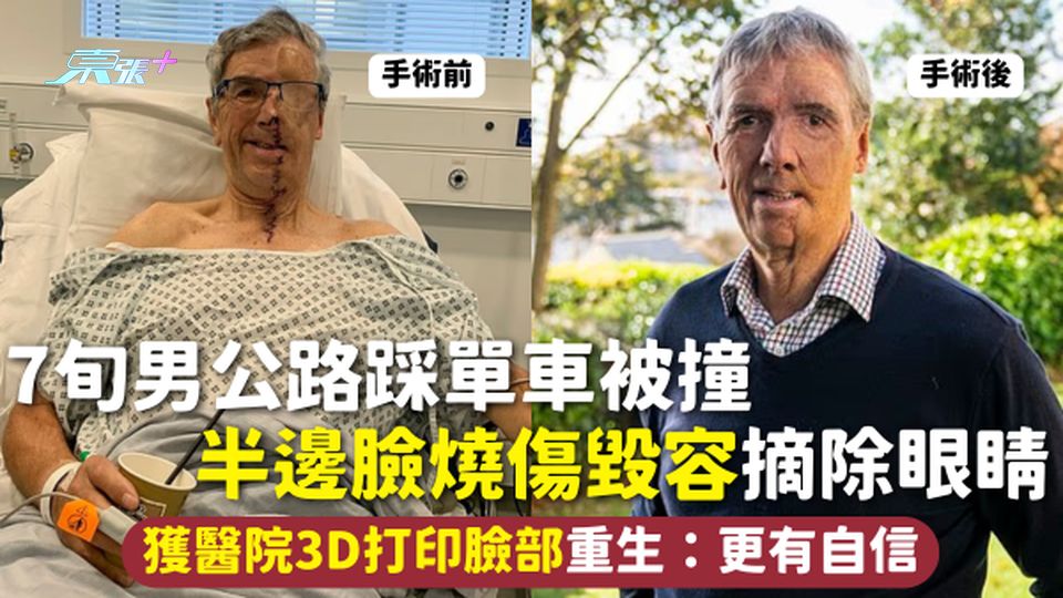 臉部重塑 | 7旬男公路踩單車被撞 半邊臉燒傷毀容摘除眼睛 獲醫院3D打印臉部重生：更有自信【有圖】