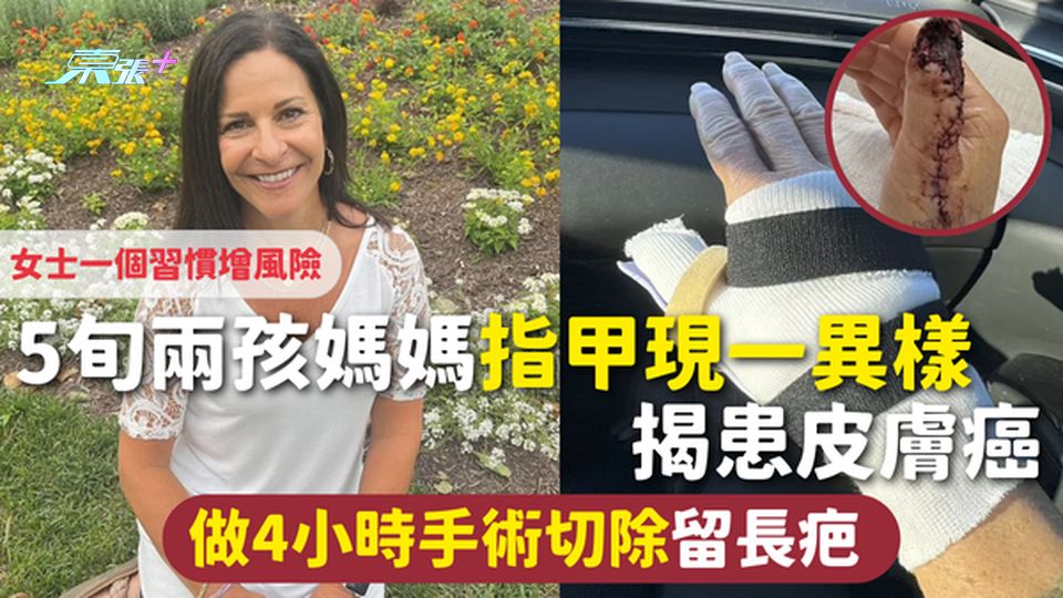 皮膚癌 | 5旬兩孩媽媽指甲現一異樣 揭患皮膚癌 做4小時手術切除留長疤 女士一個習慣增風險