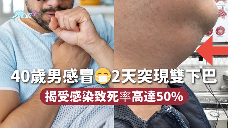 40歲男感冒😷2天突現雙下巴 揭受感染致死率高達50%