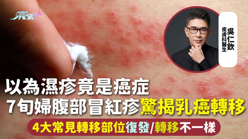 癌症轉移｜以為濕疹竟是癌症！7旬婦腹部冒紅疹驚揭乳癌轉移 4大常見轉移部位 復發/轉移不一樣