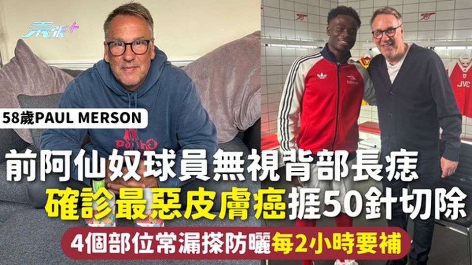 皮膚癌｜ 前阿仙奴球員無視背部長痣 確診最惡皮膚癌捱50針切除 4個部位常漏搽防曬每2小時要補