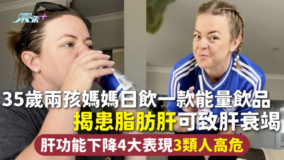 脂肪肝 | 35歲兩孩媽媽日飲一款能量飲品 揭患脂肪肝可致肝衰竭 肝功能下降4大表現3類人高危