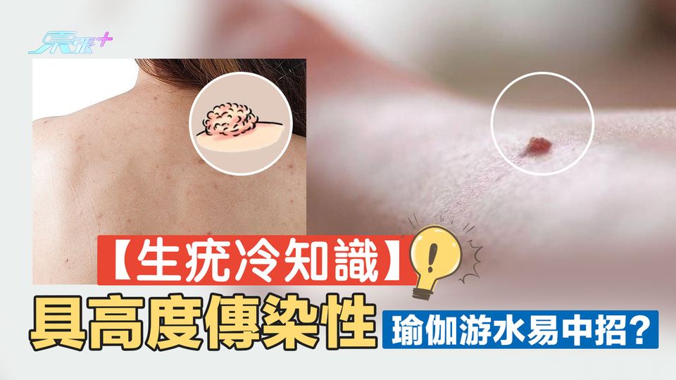 生疣冷知識｜具高度傳染性 瑜伽游水易中招？