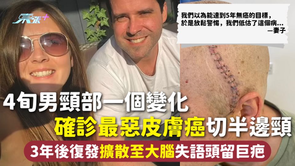 皮膚癌 | 4旬男頸部一個變化 確診最惡皮膚癌切半邊頸 3年後復發擴散至大腦失語頭留巨疤：低估這個病