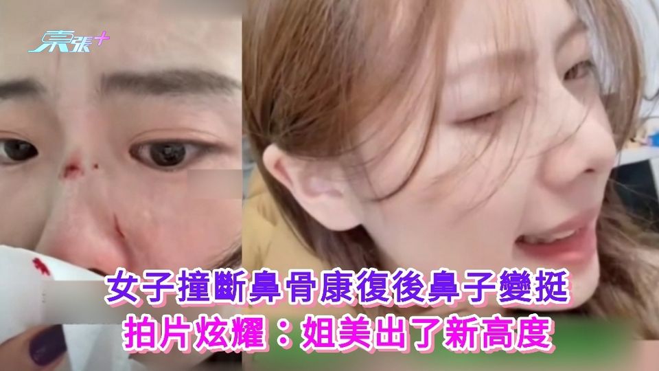 有片 | 女子撞斷鼻骨康復後鼻子變挺 拍片炫耀：姐美出了新高度