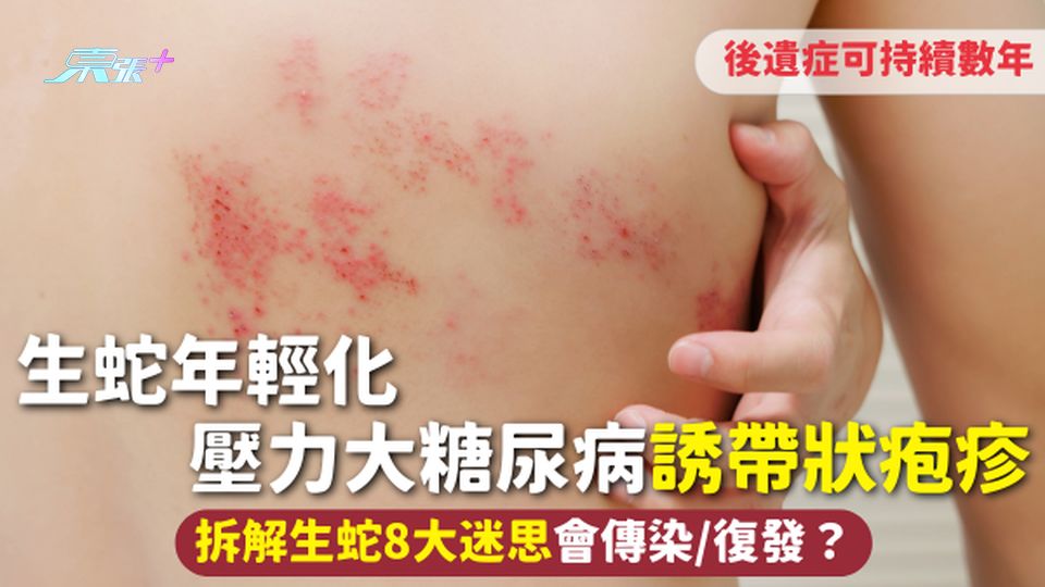生蛇 | 生蛇年輕化 壓力大糖尿病誘帶狀疱疹 拆解生蛇8大迷思會傳染/復發？後遺症可持續數年