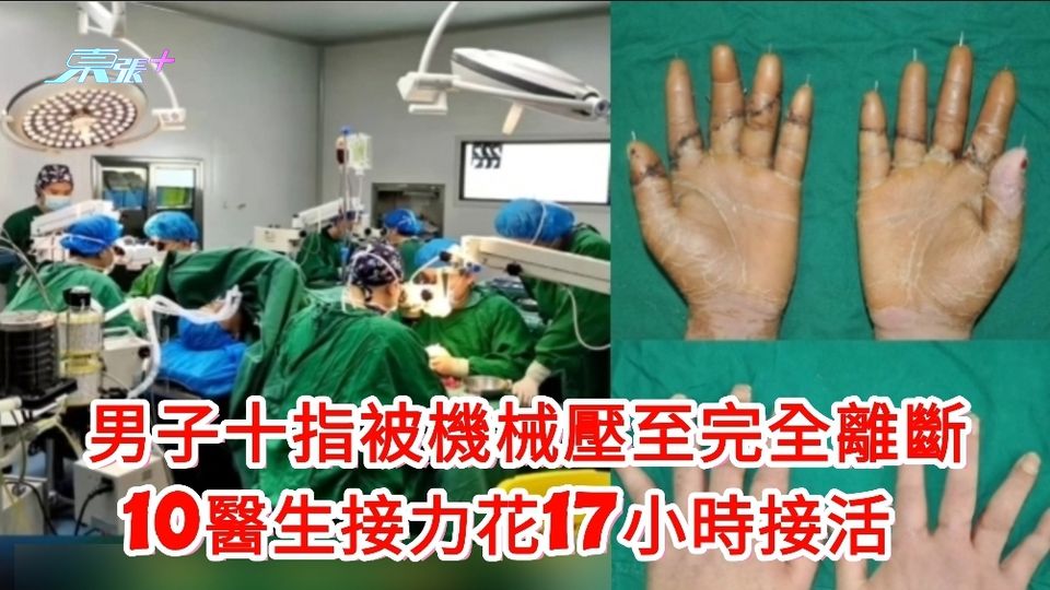 有片｜男子十指被機械壓至完全離斷 10醫生同步搶救花17小時接活