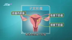 本港近七成子宮肌瘤患者無任何徵狀 醫生建議每年定期做婦科檢查