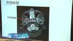 《最強生命線》：鼻咽癌 今晚八點半財經體育資訊台