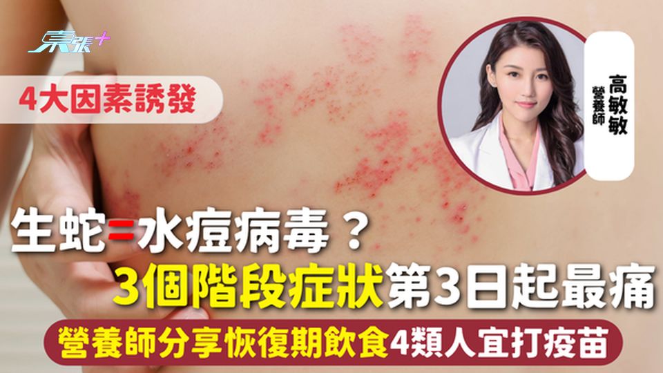 生蛇=水痘病毒？4大因素誘發 3個階段症狀第3日起最痛 營養師分享恢復期飲食 4類人宜打疫苗