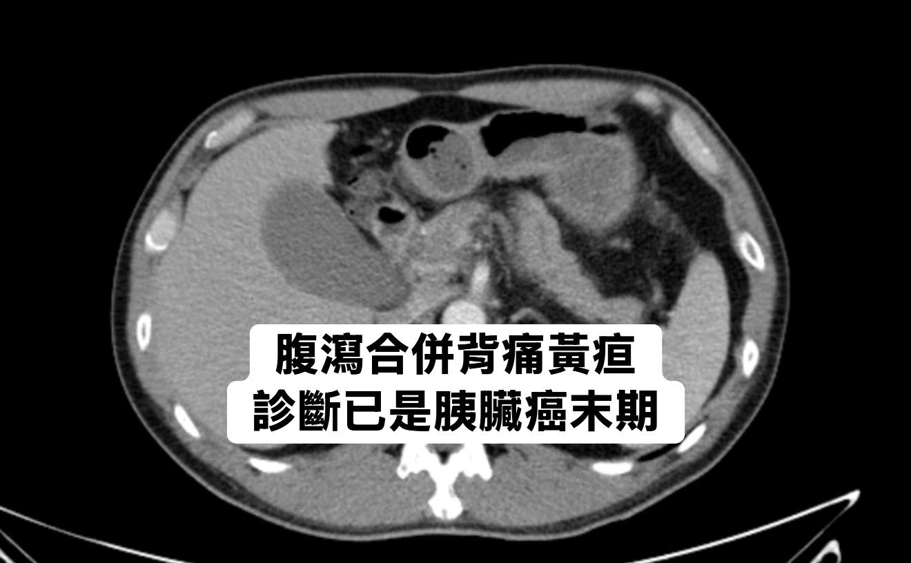 May be an image of xray and text that says '腹鴻合併背痛黃痘 診斷已是胰臟癌末期'