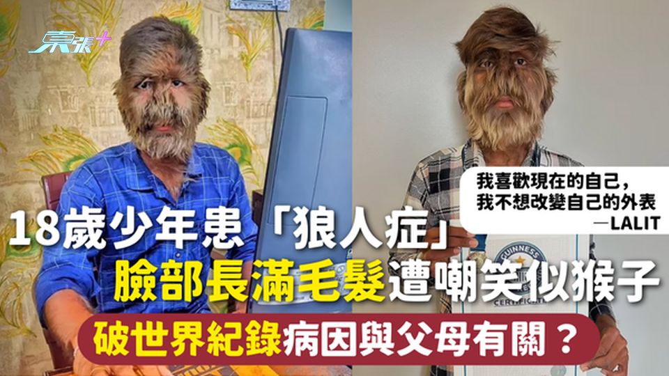 罕見病 | 18歲少年患「狼人症」 臉部長滿毛髮遭嘲笑似猴子 破世界紀錄 病因與父母有關？
