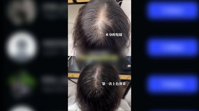 宣傳片所見，做完後少女頭頂髮量看似濃密了。