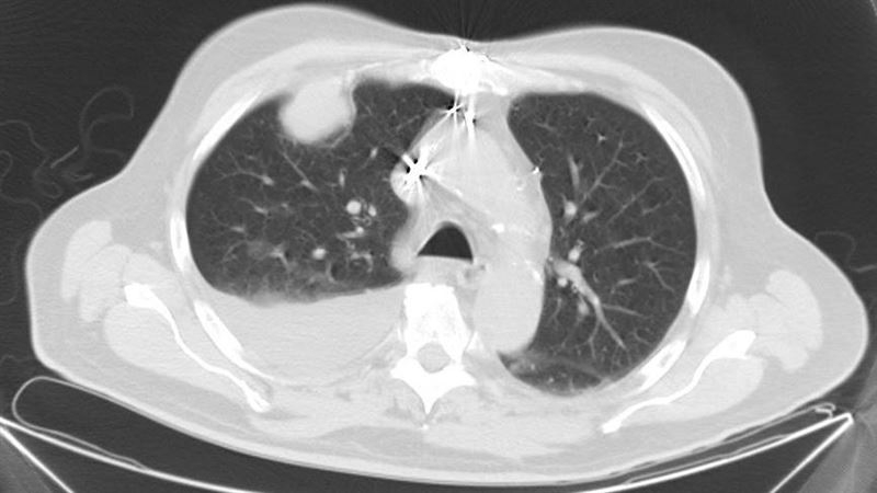 獨家／堪比胰臟癌！罕見惡性肋膜間皮瘤「9死1生」 6旬男成功翻轉命運| 祝你健康| 三立新聞網HEALTH.SETN.COM