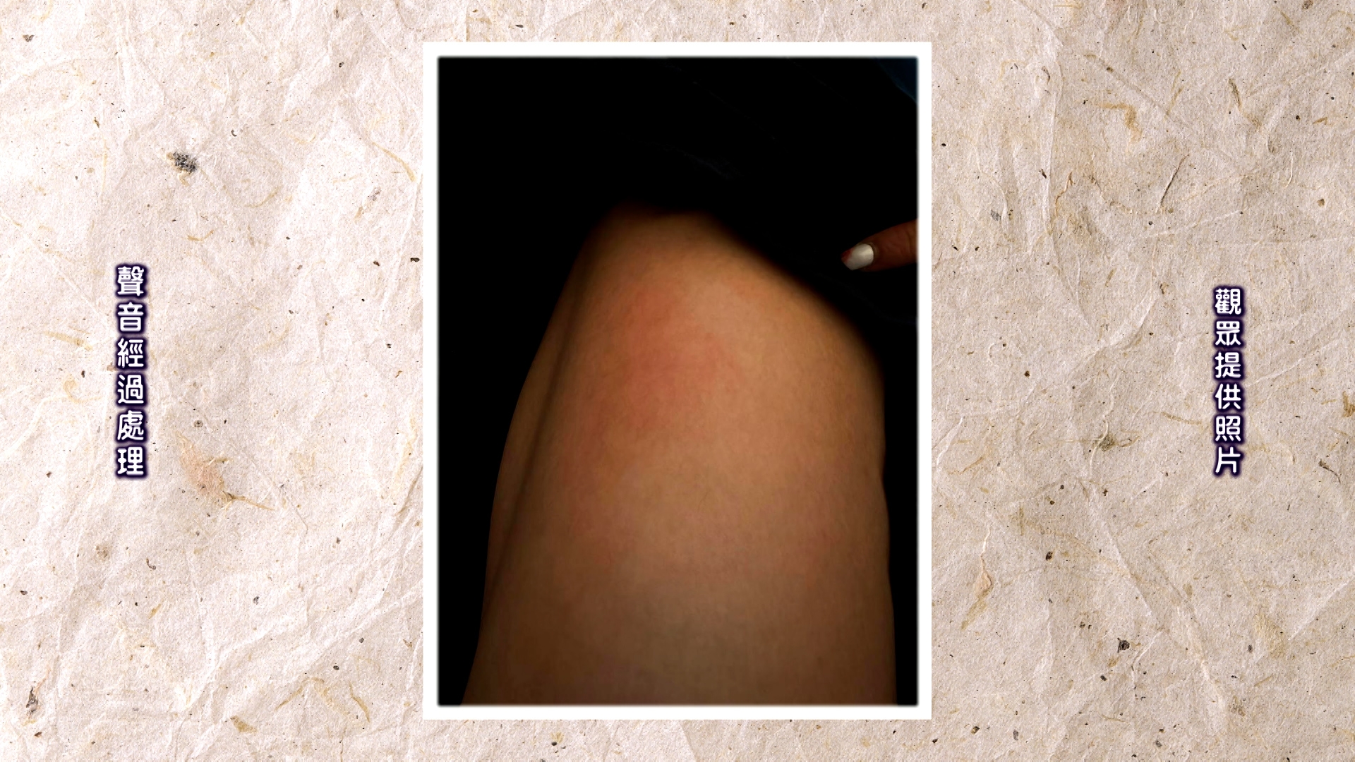 傷處當場紅腫疼痛，半個月後仍留有明顯紅印，恐會留下疤痕。