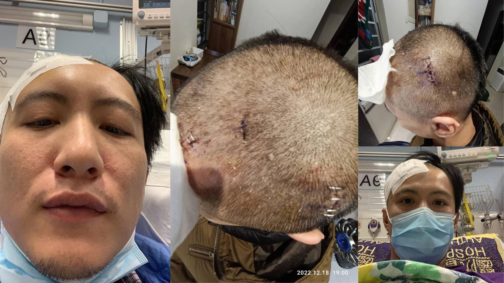 因葵早前流出嘅照片可見周永恒臉部、額頭、耳背及鎖骨均有明顯傷痕。