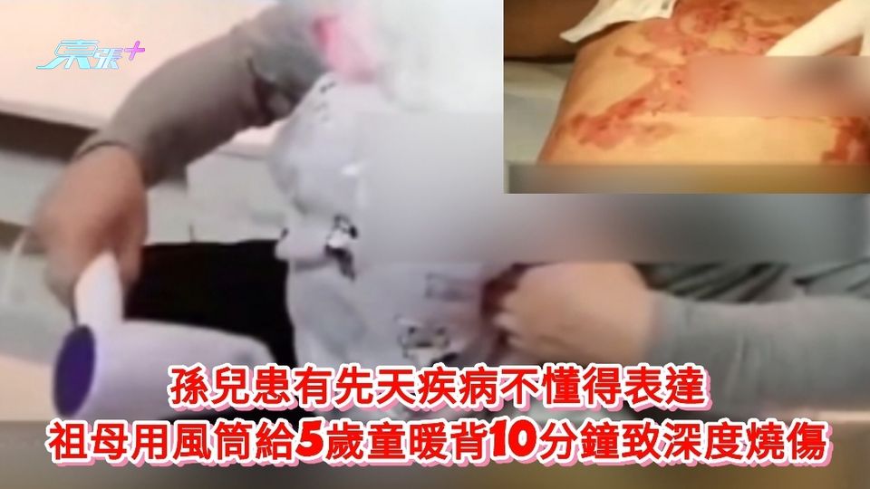 孫兒患有先天疾病不懂得表達 祖母用風筒給5歲童暖背10分鐘致深度燒傷