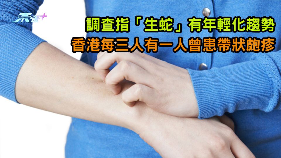 調查指「生蛇」有年輕化趨勢　 香港每三人有一人曾患帶狀皰疹