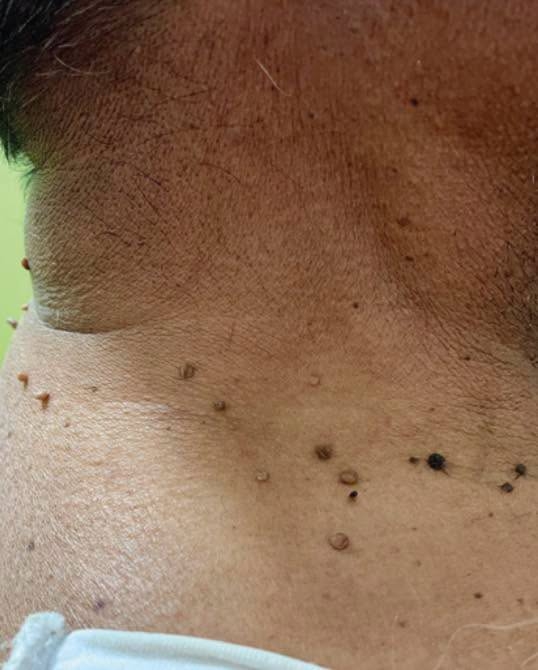 May be an image of tick and acupuncture